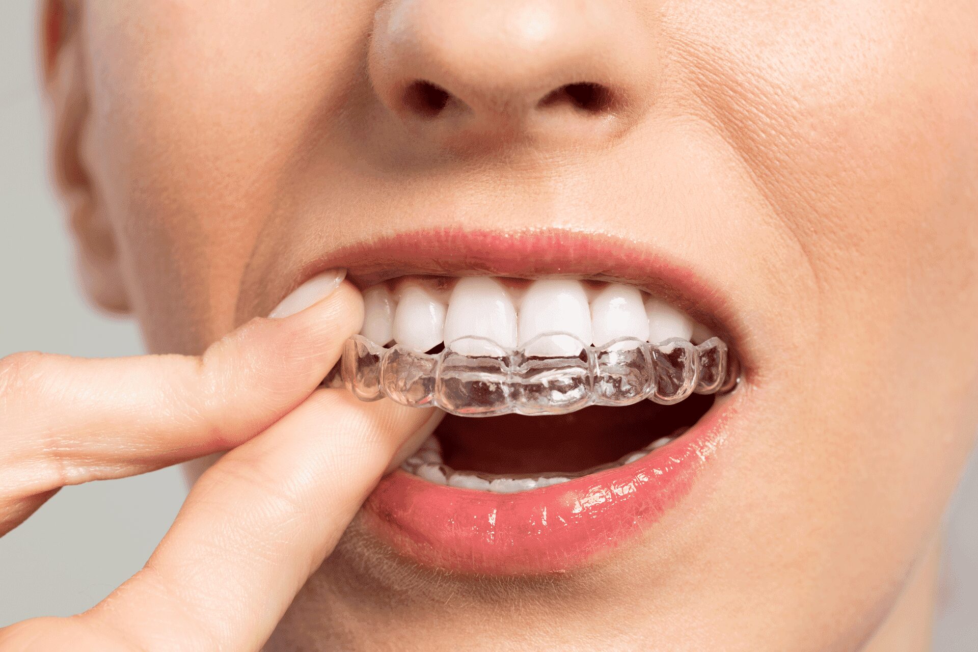 How Invisalign Braces Treatment Cost Impacts Your Smile Transformation