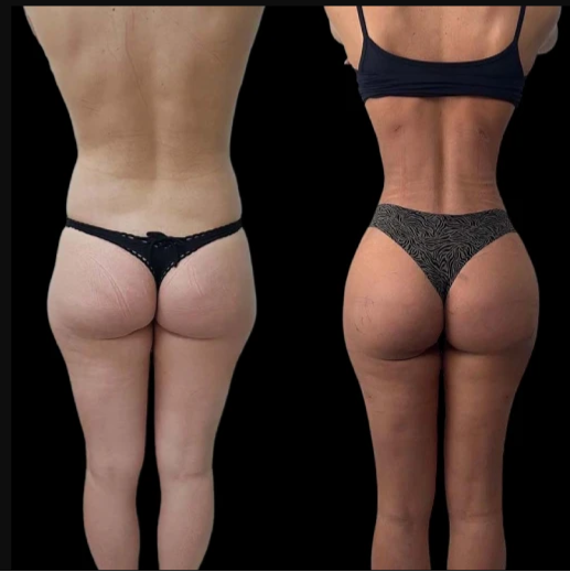 J-Plasma in Dubai Setting New Standards in Cosmetic Treatments