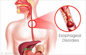 Understanding Esophageal Disorders: Symptoms, Causes, and Lifestyle Support
