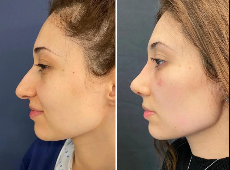 Dubai as a Leading Destination for Fat Grafting