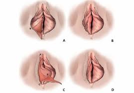 Vaginal Implant Surgery: A Contemporary Solution for Restoring Internal Strength and Intimate Comfort