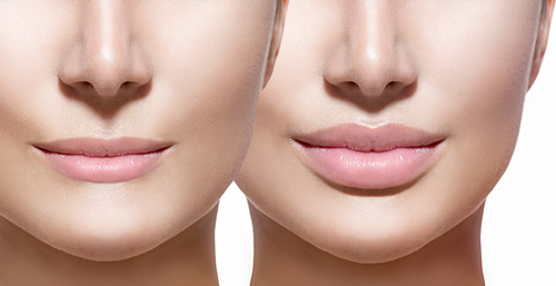 Why Lip Fillers Are Now About Balance Not Volume