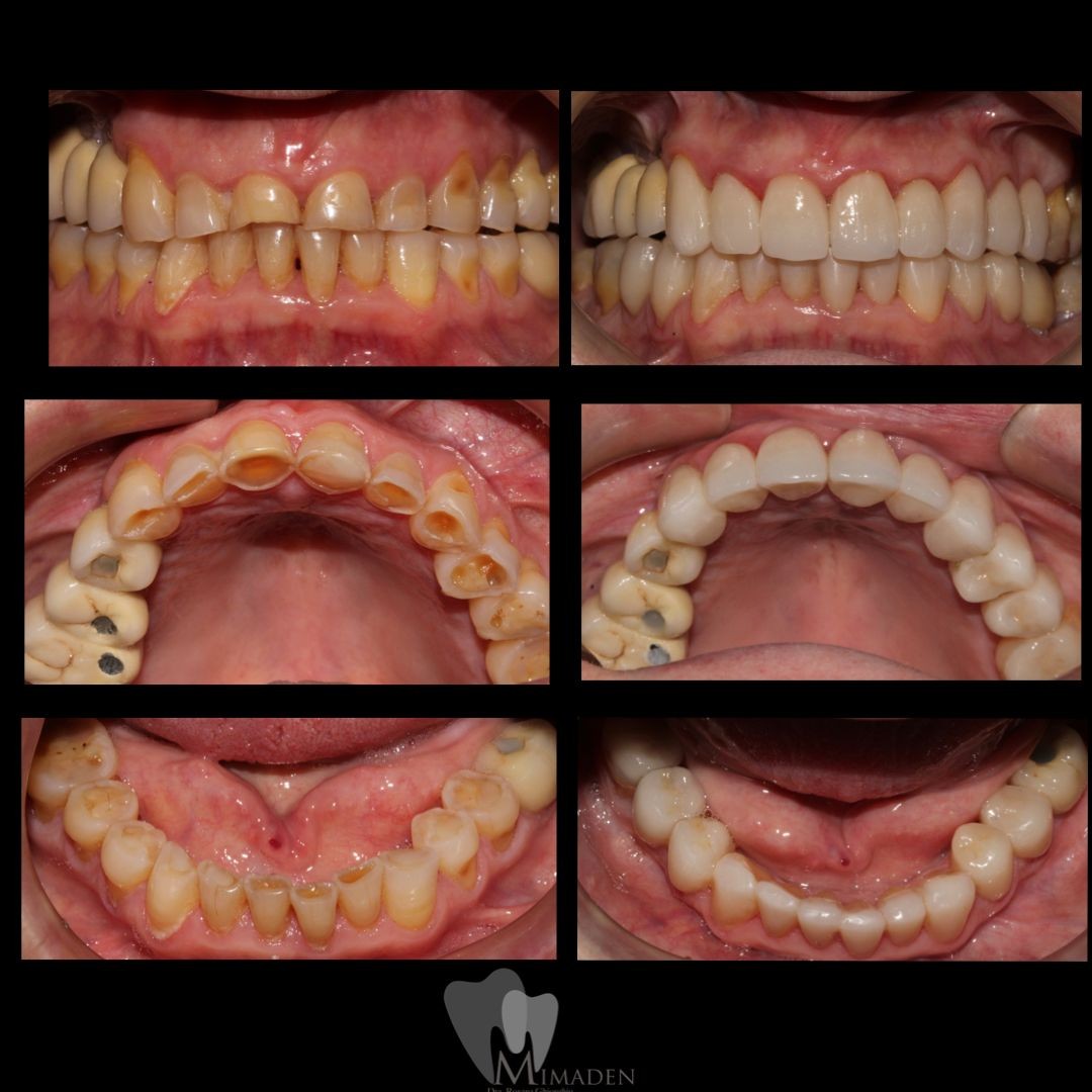 Blanqueamiento Dental en Hospitalet de Llobregat Dientes Más Blancos y Brillantes