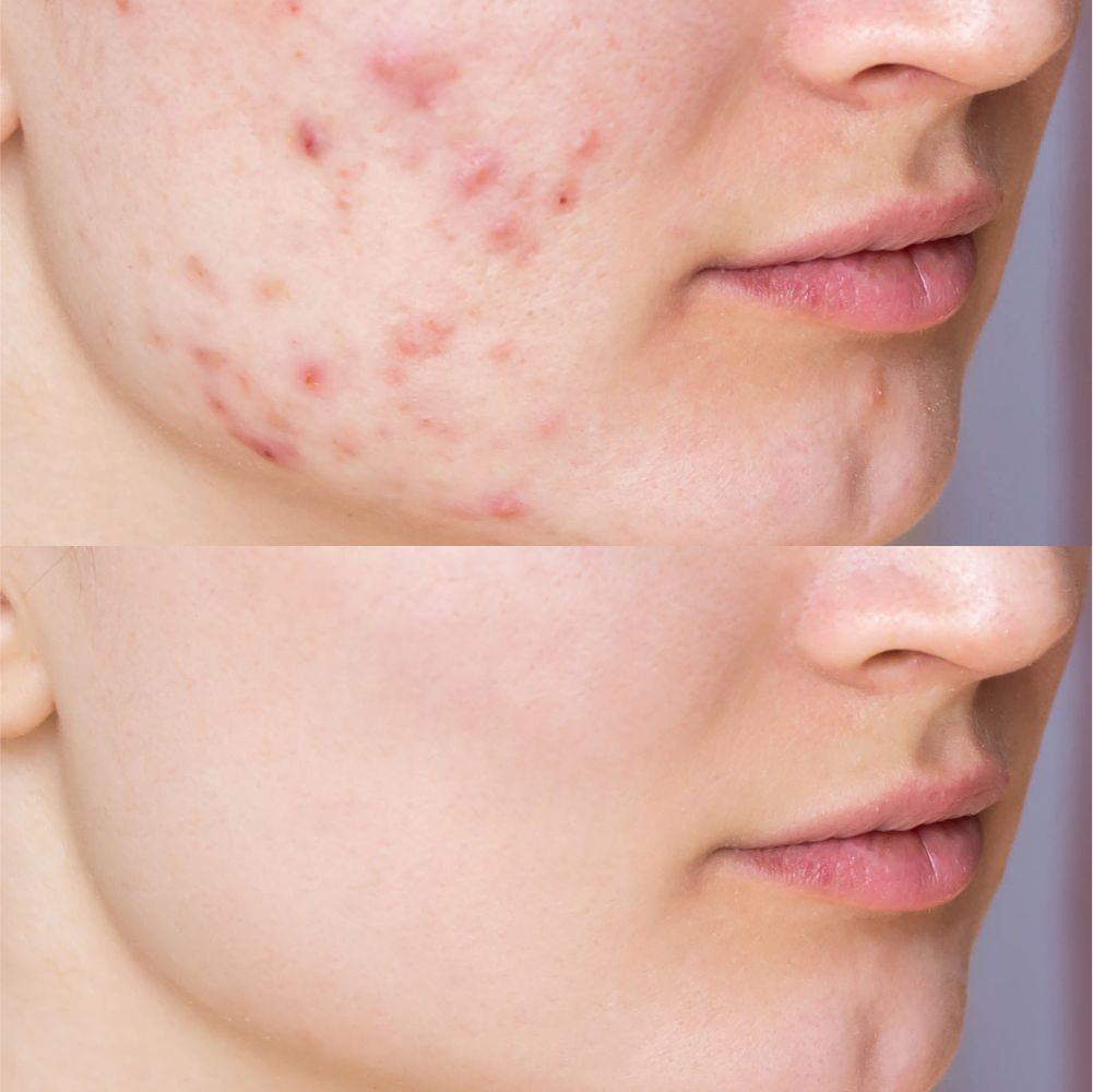 Acne Scar Treatment In Islamabad: Everything You Need to Know