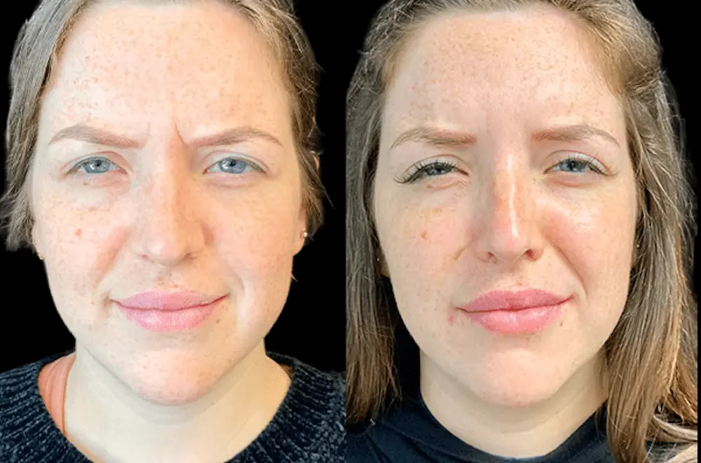 Non-Surgical Facial Rejuvenation with Botox in Dubai