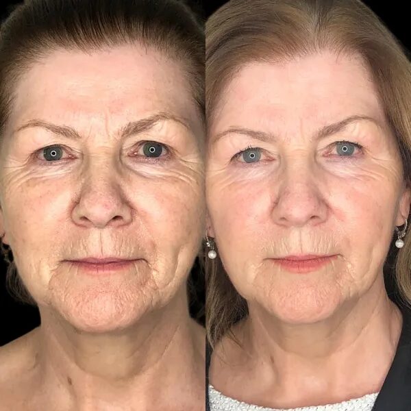 Profhilo Treatments in Dubai for Advanced HA Skin Integration