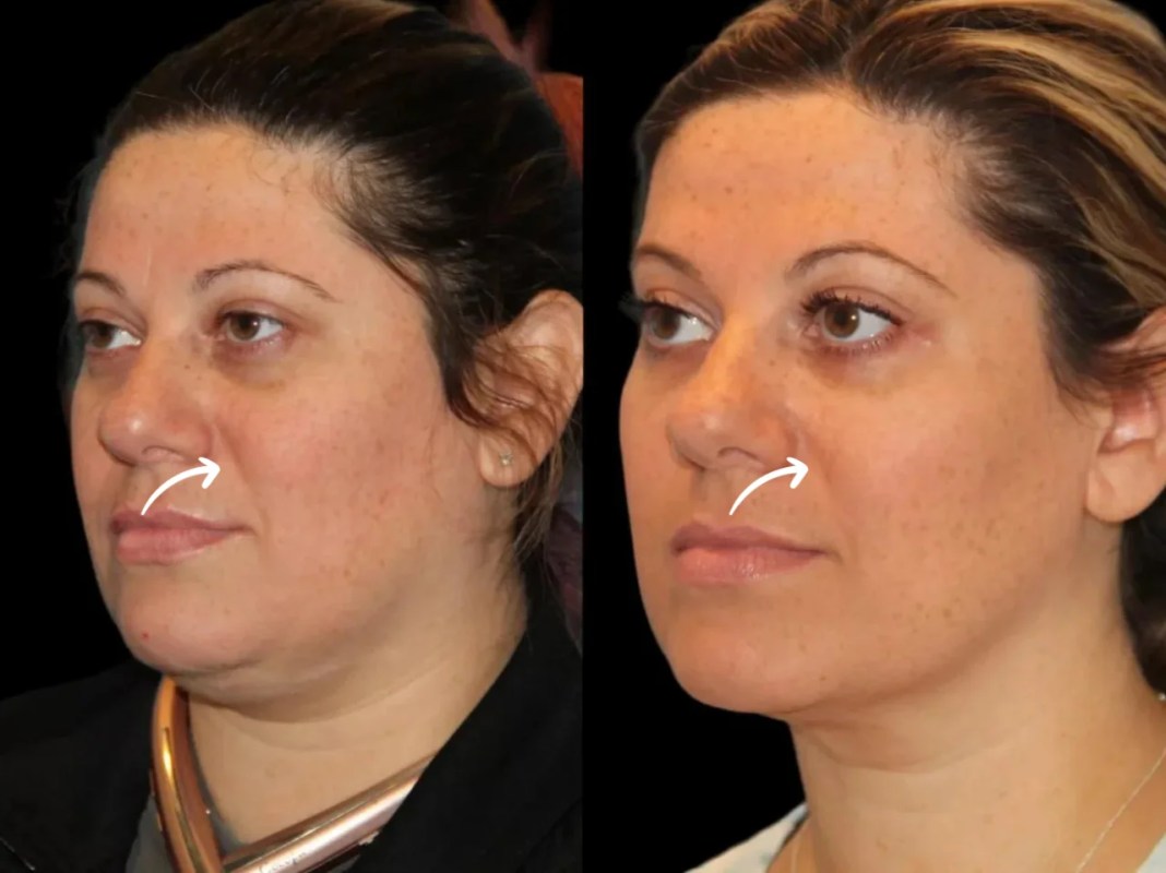 Sculptra Fillers Treatment in Dubai for Beach Season
