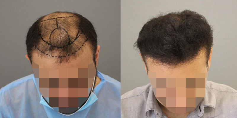 Myths vs. Facts: The Truth About Hair Transplant in Riyadh