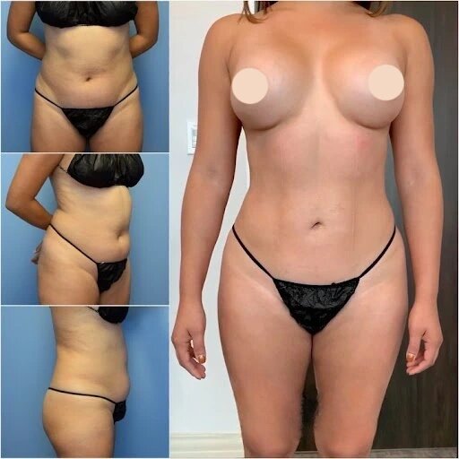 Leading Best Body Contouring Surgeons in Dubai: Expertise You Can Count On