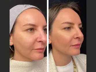 Mesotherapy in Dubai How to Choose the Right One