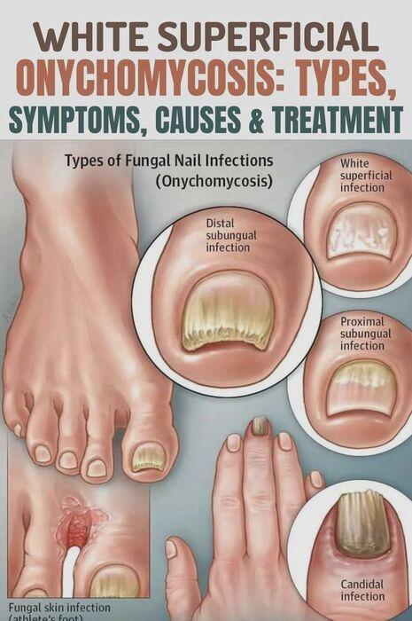Onychomycosis – Complete Nail Fungus Care Guide