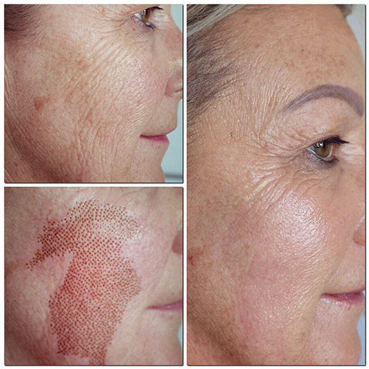 Transform Your Skin Instantly With Plasma Pen Treatment Magic