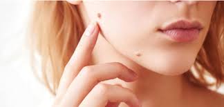 Are Skin Tags Dangerous? When to Seek Removal in Islamabad