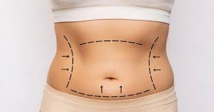 Tummy Tuck vs Liposuction in Islamabad: Key Differences