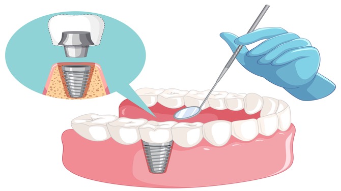 Are Dental Implants Right for You? Key Factors to Consider