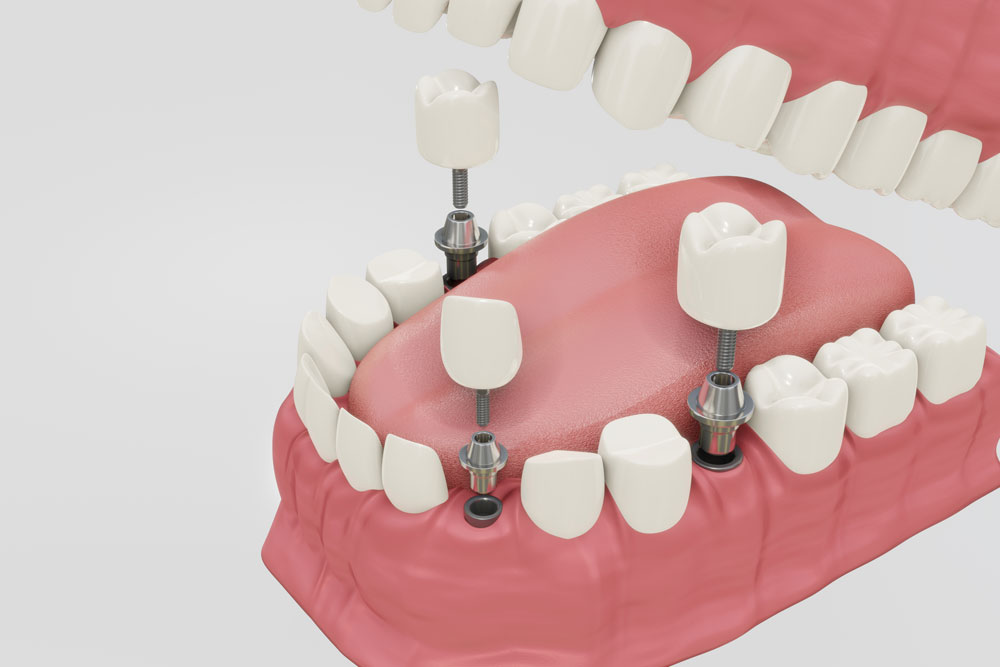 Can Dental Implants Restore Harmony Between Teeth, Bite, and Jawline