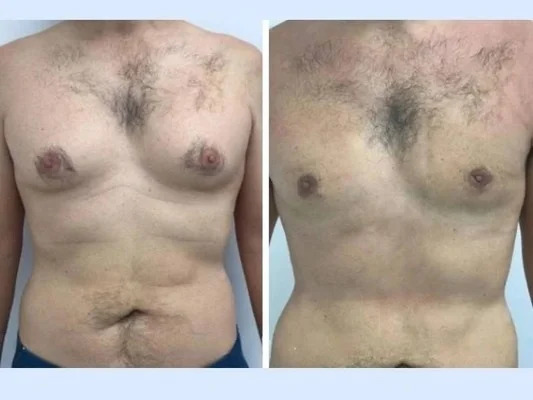 gynecomastia-in-dubai.jpg-1