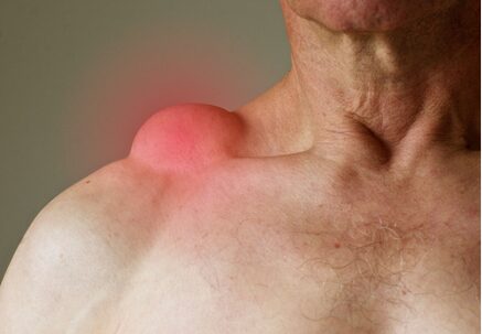 Lipoma vs Cyst: How Islamabad Clinics Treat Them Differently