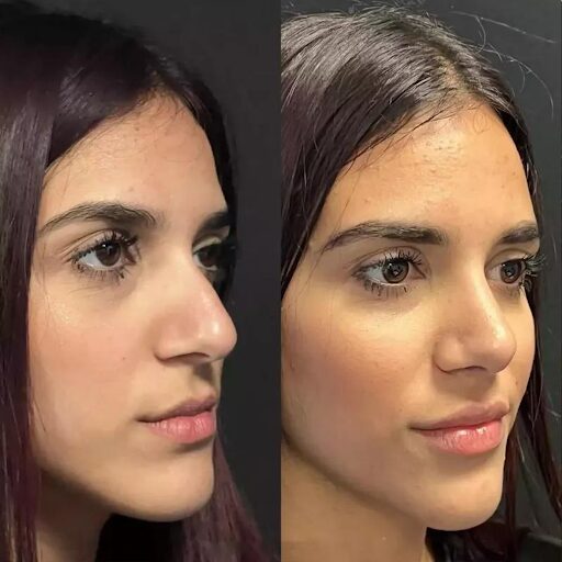 Best Rhinoplasty Surgeon in Dubai for Structural Nose Correction