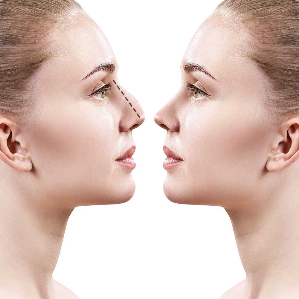 Who Is a Good Candidate for Rhinoplasty in Islamabad?