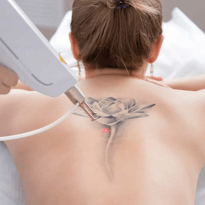 Does Tattoo Removal Hurt? Honest Guide for Islamabad Residents
