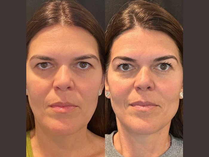 Thread Lift vs Facelift: Insights from Best Plastic Surgeons in dubai