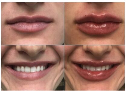 Bioidentical Hormone Replacement in PA & Lehigh Valley