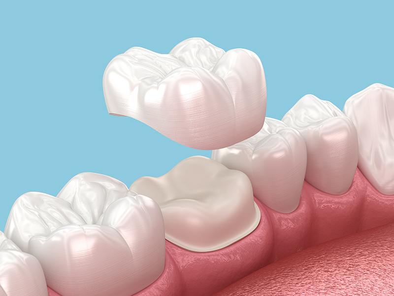 Dental Crowns and Bridges Dubai: Strengthen and Enhance Your Teeth
