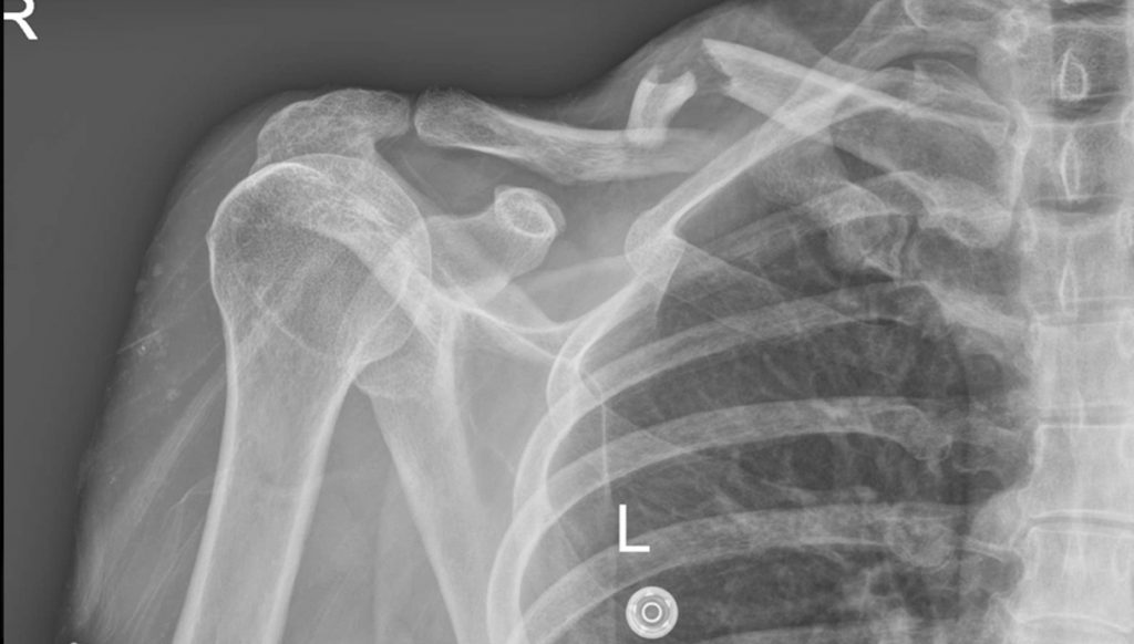 Fractures & Dislocations: Early Signs and Treatment