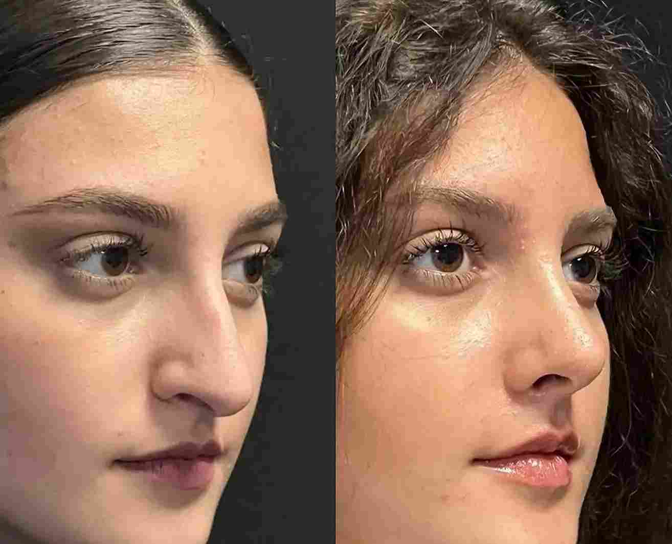 Why Is Expertise Important for Best Rhinoplasty Surgeons in Dubai?