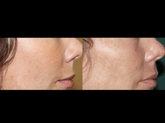 High-Precision Fractional RF Microneedling by the Best Plastic Surgeons in Dubai