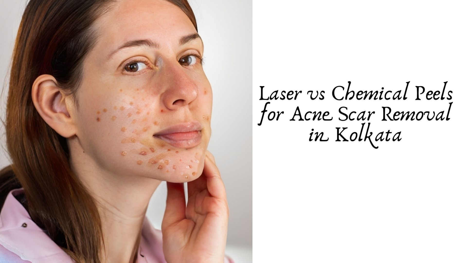 Laser vs Chemical Peels for Acne Scar Removal in Kolkata