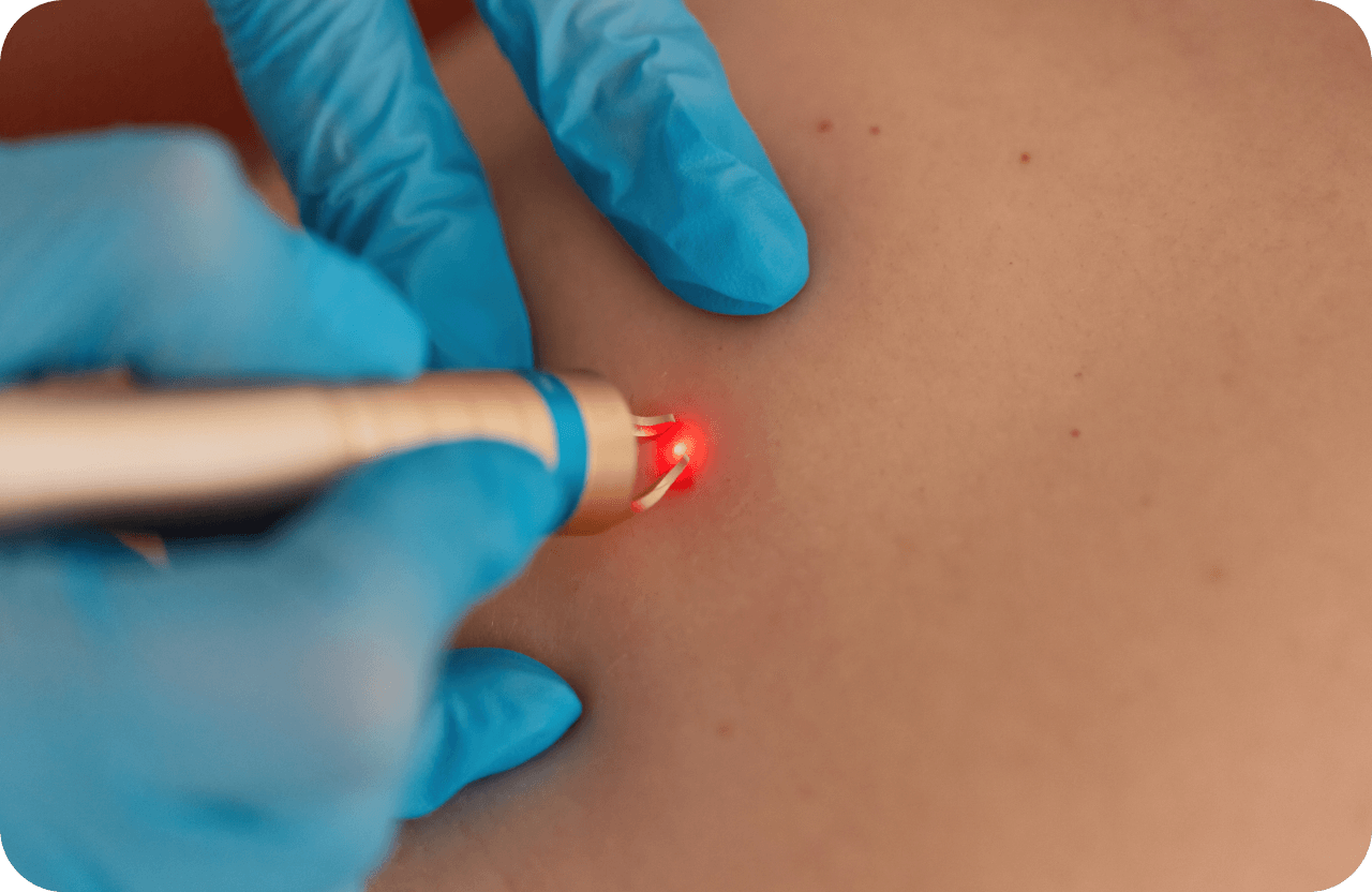 Skin Tags Removal in Dubai: Your Comprehensive Guide to Smooth