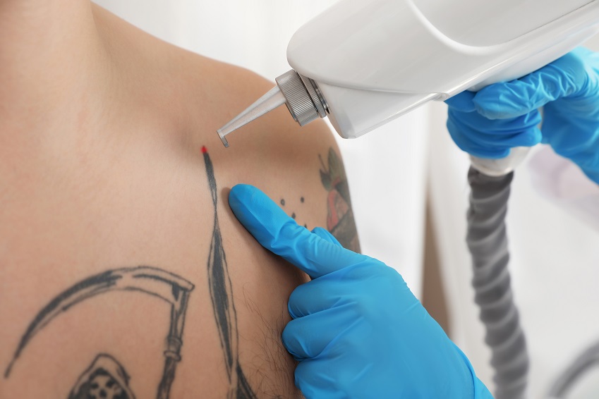 Is Picosure Laser Tattoo Removal the Ultimate Tattoo Removal Breakthrough