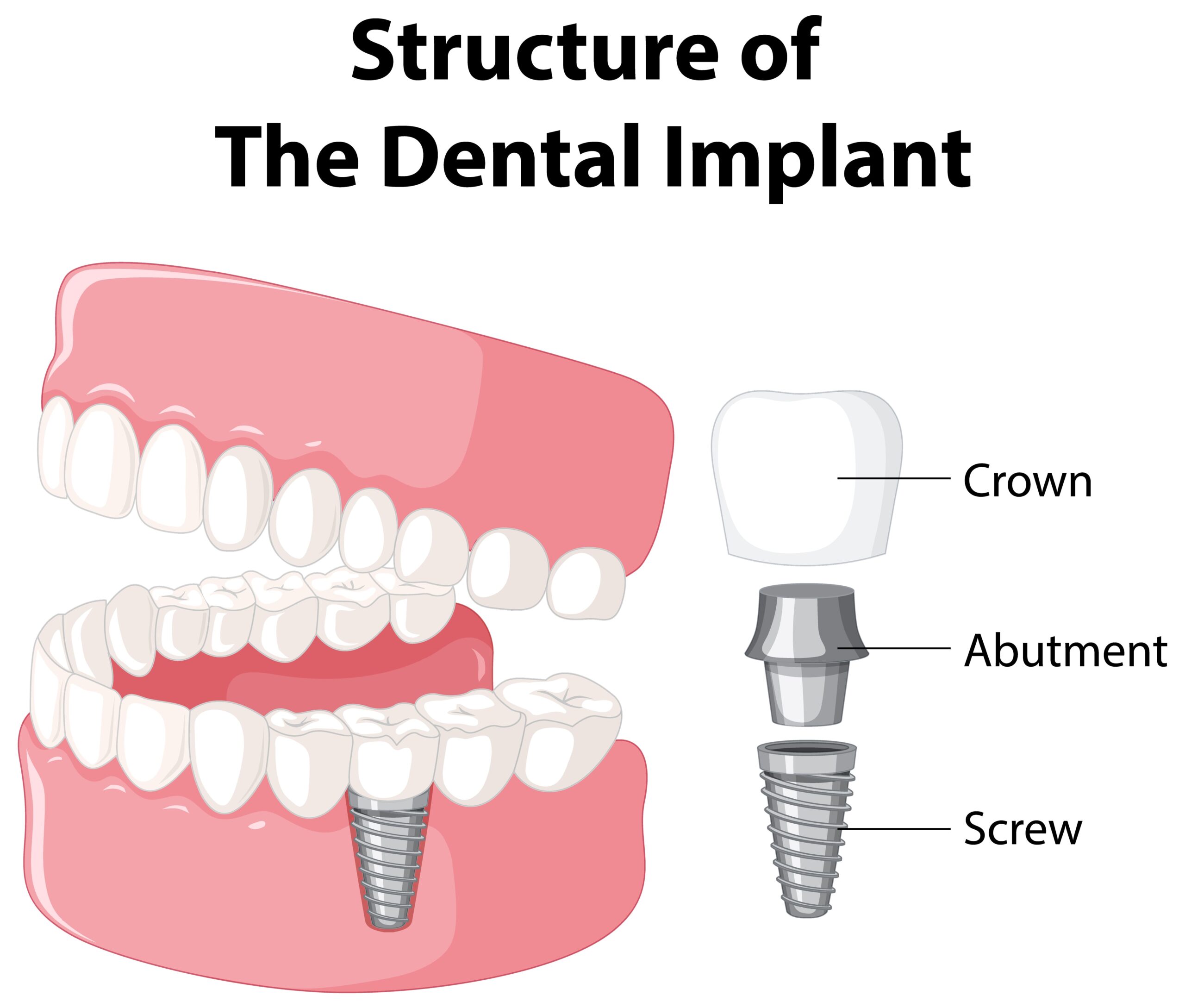 How to Choose the Right Clinic for Dental Implants in Southeast London