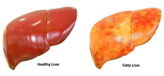 Fatty Liver: Causes, Symptoms, Prevention, and Treatment Guide
