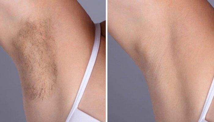 Best Plastic Surgeon in dubai Discuss Body Electrolysis Laser Hair Removal in Dubai