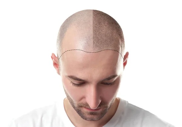 Can hair transplant fix hair density permanently?
