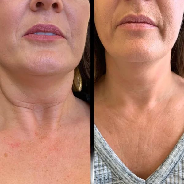 How Do Profhilo Treatments in Dubai Enhance Facial Hydration?