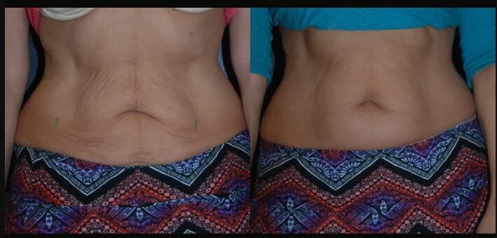 Best Doctors in Dubai for Skin Tightening Excellence