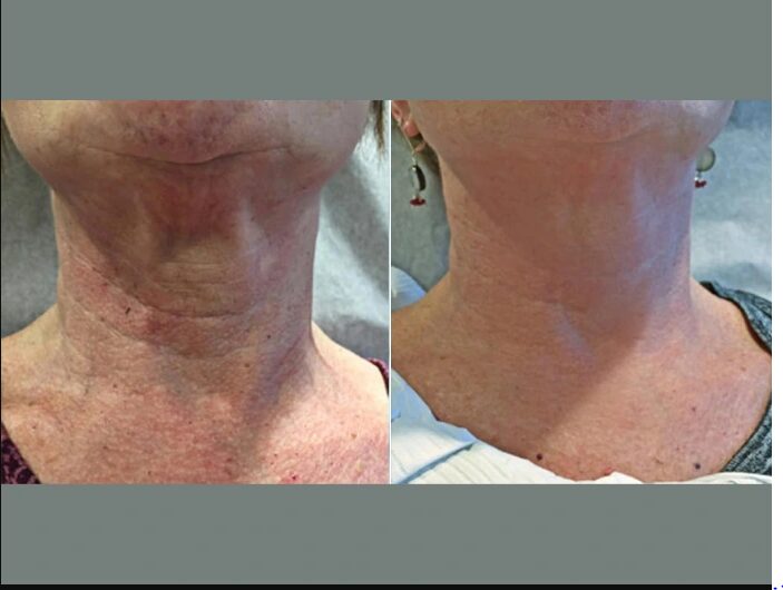 Finding the Best Skin Tightening Treatment in Dubai