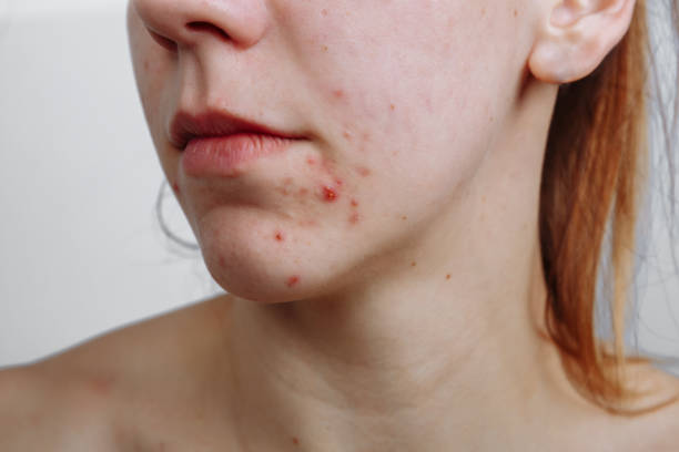Can Acne Treatment fix sudden acne breakouts fast?