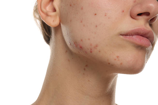 Can Laser Acne Scar Treatment Even Skin Tone?