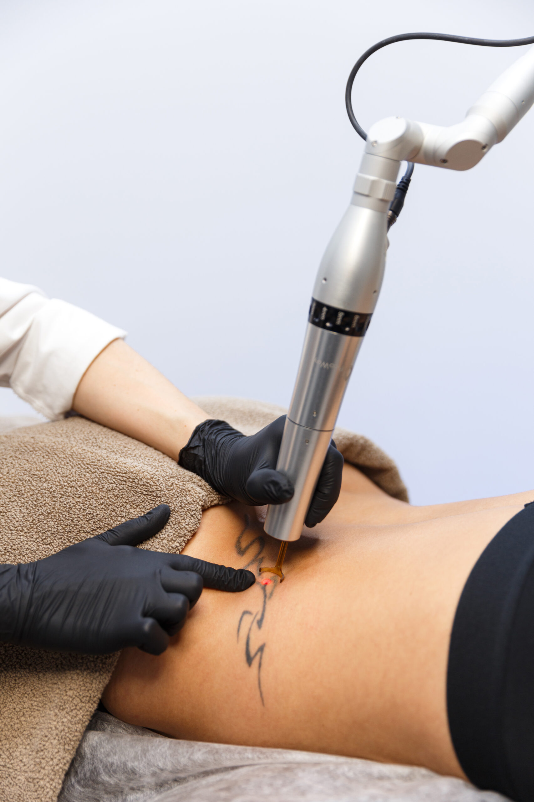 Can Laser Tattoo Removal Reduce Tattoo Visibility Permanently?