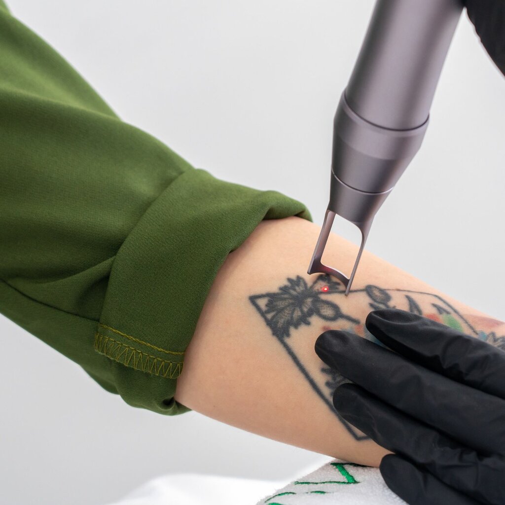 Can Laser Tattoo Removal Work on Tattoos With Dark Shades?