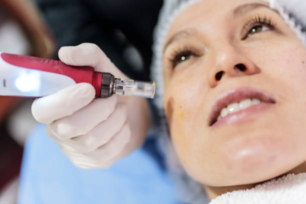 Can Microneedling Improve Skin Glow Naturally?