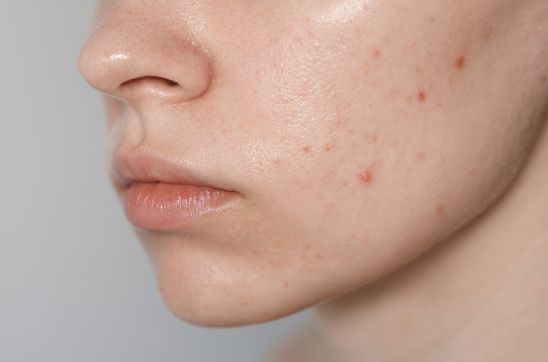 Can Pimples Treatment Improve Skin Resilience Against Pimples?
