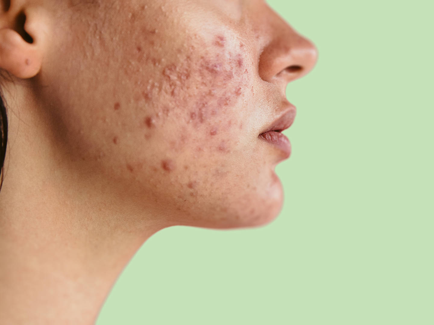 Can Best Pimples Treatment Remove Dark Spots Too?