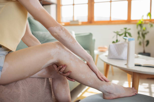 Can targeted therapy enhance vitiligo treatment ?