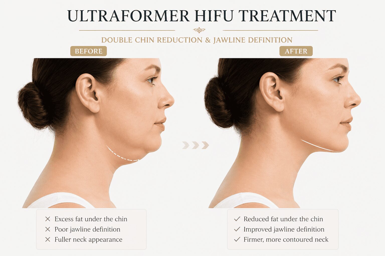 Tired of Your Double Chin? Here Is What Melbourne Patients Are Choosing Instead of Surgery